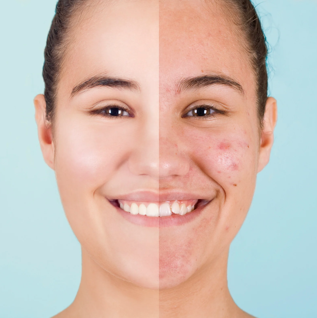 acné de grossesse, acné hormonal, traitement naturel pour une peau nette, nettoyant, crème, et protection solaire pour aider à diminuer boutons et imperfections