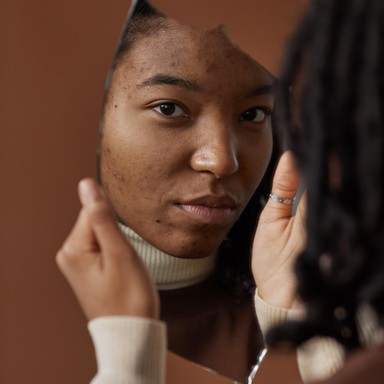 Soins visage naturels pour l’acné hormonale pendant la grossesse et le post-partum