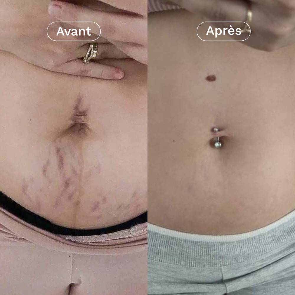 Comparatif avant/après sur le ventre : atténuation visible des vergetures grâce à la crème L’Expert Omum.