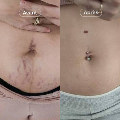 Comparatif avant/après sur le ventre : atténuation visible des vergetures grâce à la crème L’Expert Omum.