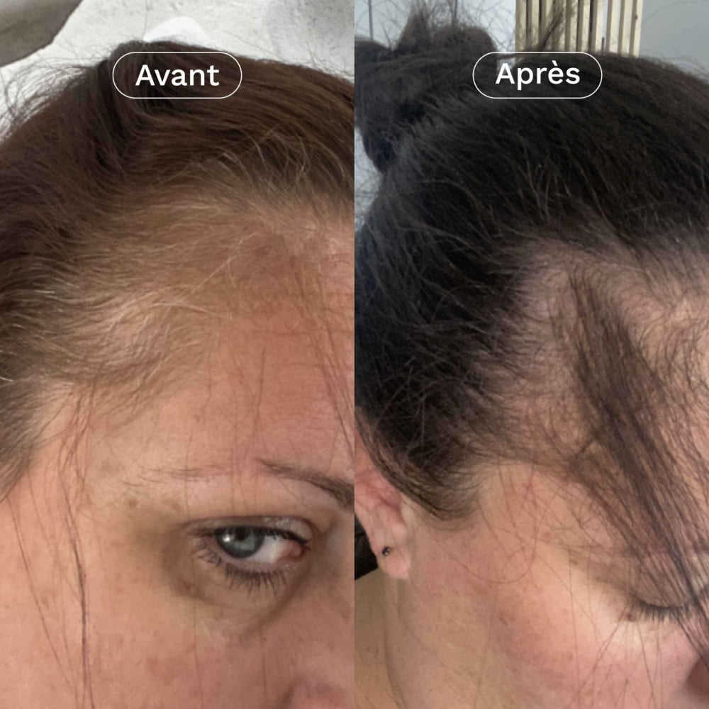 Avant après perte de cheveux post-partum – repousse et cheveux plus épais avec Mon Coup de Pousse Omum.