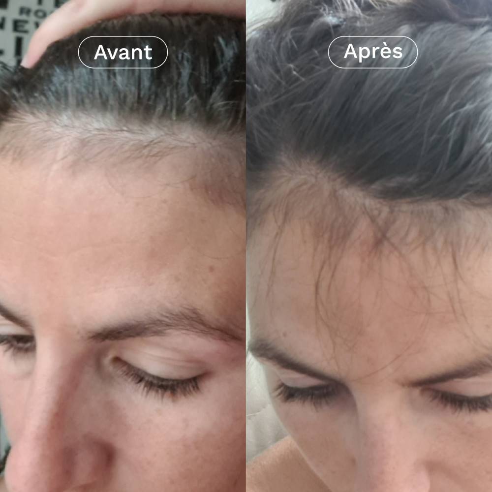 Avant après cure Omum Mon Coup de Pousse – densité et repousse visibles après 2 mois d’utilisation.