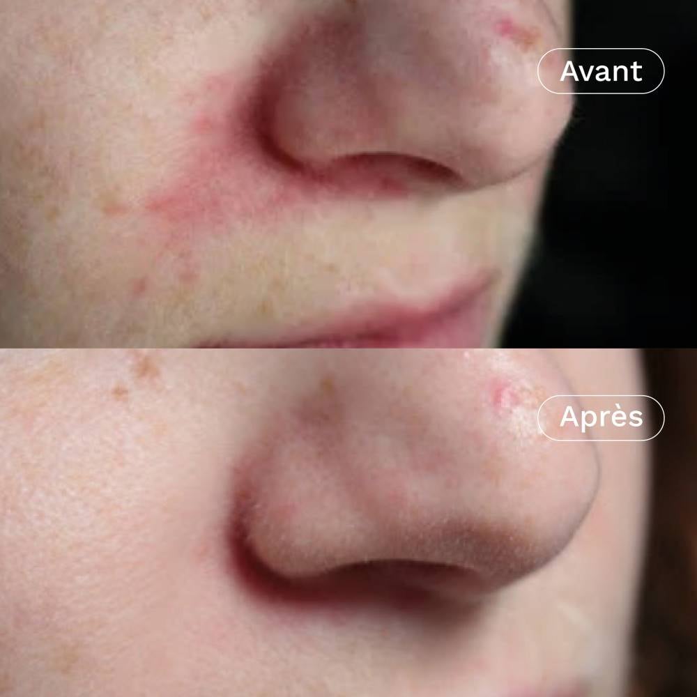 Crème Visage - Rééquilibrante - Peaux mixtes, Anti-rougeurs, Anti boutons